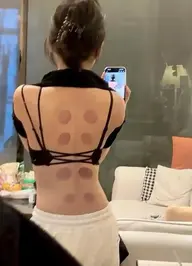 👯‍♀️追加メニュー全身カッピング吸引10分