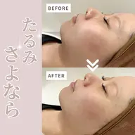 まるで糸リフト級のリフトアップ‼️『chulaリフト』