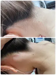 【全員】ブラジリアンワックス☆うなじ脱毛/アップスタイルや短髪の時に気になる産毛を除去♪