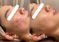 💚18～22歳限定価格”💚最高峰ハーブトリートメント 【ニキビ・ニキビ跡・毛穴】