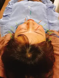 👑美容鍼➕小顔矯正👑初回ご来院から１ヶ月以内で30%オフ