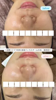 《毛穴のざらつき・つまり解消❣️》ピーリング×ハイドラ毛穴洗浄+水光パック✨