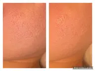 肌荒れ改善コース９０分｜8000円　しつこいニキビや繰り返しできるニキビでお悩みの方へ。根本的改善コース