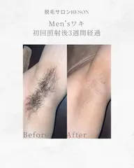 メンズ全身脱毛（ヒゲ・VIO除く）