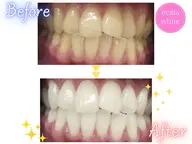 【minimo 掲載記念】セルフホワイトニング【9 分×2 回】 ¥980 別途料金なし