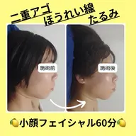 【大人気】韓国発🇰🇷美容液導入🍋小顔フェイシャル60分