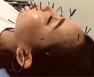 【💐美顔と健康のコース】🪡美顔鍼、ヘッドマッサージ、通常11,000→2,980円✨お顔の血流改善❗️