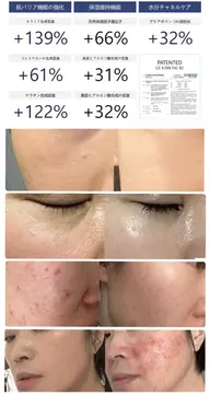 本気で肌質改善したい方♪韓国式科学的スキンケア⇒刺さずに、肌の奥へ