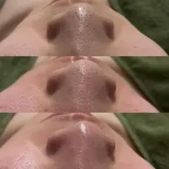 鼻,顎,眉間の気になる部分の角栓,黒ずみ除去【溶ける毛穴吸引＆洗浄】￥5980