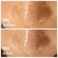 【黒ずみ/角栓/ザラツキ/開き】毛穴洗浄血流リンパ&マッサージ+美容液導入　60分