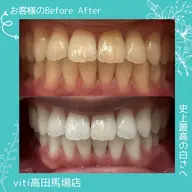 🩵美容🩵セルフホワイトニング20分+カウンセリング