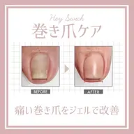 【フット親指巻き爪ケア＊Hey Switch】特殊な専用ジェルで痛みなくゆっくり時間をかけてケアします！
