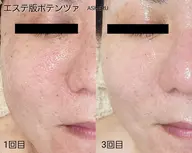 💎【凸凹跡・ニキビ跡・毛穴ケア】最新美容導入でつるん肌へ