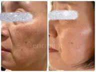 整形級スキンケア体験