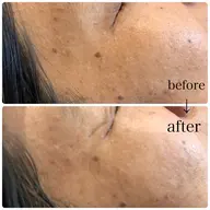 期間限定お試し価格❣️シミ20分取り放題半額！！✨通常¥8,800→¥6,600！！✨