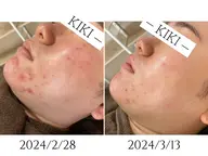 【68％オフ‼️】【ハーブピーリング｜ニキビ徹底ケア◎】カウンセリング込み120min(31,900円→10,000円)