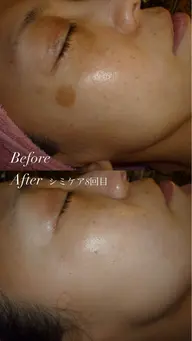 【限定10名】夏前にシミ悩み撃退！シミケア