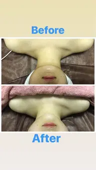 小顔60分お悩みに合わせてラジオ波、ハンドマッサージで施術をします。