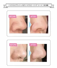 【徹底毛穴洗浄】   ハイドロ毛穴フェイシャル+デコルテケア ¥7000→¥6500