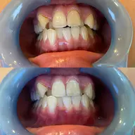 歯のセルフホワイトニング🦷となります。全てご自身でしていただく施術となります。