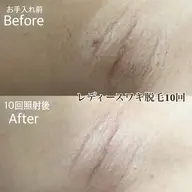 【ワンコイン】ワキ脱毛（レディース・メンズ）¥500