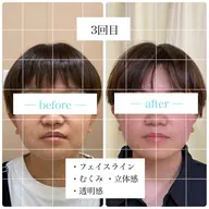 🌈美容鍼(刺さない)➕筋肉ほぐし➕美顔器(リフトアップ)🌈速攻劇的小顔効果