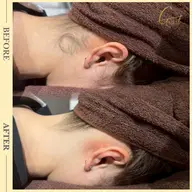 まとまらない【癖毛うなじでお悩み】生えムラもスッキリ✨️癖毛矯正うなじ脱毛