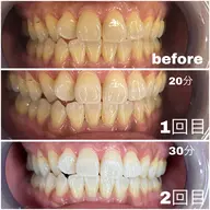 初回価格《セルフホワイトニング》