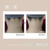 うなじ脱毛