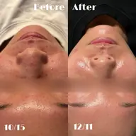 【4月限定先着10名のみ‼️ごっそり毛穴撃退】毛穴洗浄