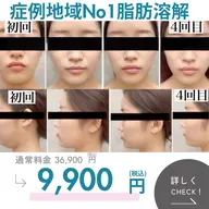 注射なし脂肪|1回でスッキリ小顔実感✨デコルテマッサージ付き