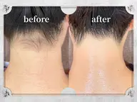 【新規/男女OK】うなじ脱毛/¥2000☆★30分