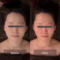 【ご新規様＊凝り浮腫み】頭蓋骨小顔矯正＋超音波ケア　通常16,000円→ミニモ限定初回10,700円