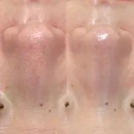 【新規】『鼻ピーリング』(小鼻の黒ずみ.毛穴ケアに◎】ハーブピーリング(鼻)