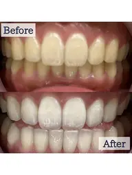 【❤️‍🔥1日で効果を実感したい方❤️‍🔥】5分照射×6回🦷照射パワーが通常の約2倍の最新セルフホワイトニング🎶