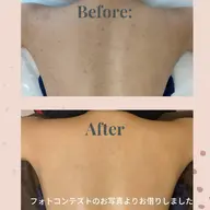【背中ピーリング】ニキビ跡、ニキビ、シミなど✨自分ではケアしにくい背中のお悩みに集中ケア😉潤いながらつるるん肌に✨