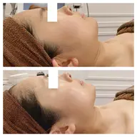 小顔ハイパーナイフEX