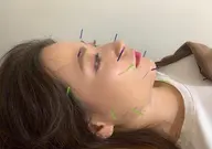 美容鍼(針)＋肩甲骨剥がし🌸