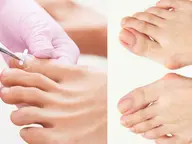 【巻き爪矯正プレート装着(1枚)】爪周囲の角質ケアつき⚠️伸びてくると食い込んでしまう中〜軽度の巻き爪・陥入爪に🦶