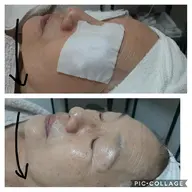 【リピートNo.1✨】小顔　美白　透明感　ヒアルロン酸たっぷりフェイシャルベーシックエステ