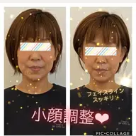 ⭐️マスクからみえるリフトアップ小顔💕特別価格⭐️【ミニモ限定】💄メイクそのままで♡リンパ小顔調整^ ^