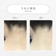 🌸うなじ＆背中脱毛《限定⛄️》スペシャルクーポン♪