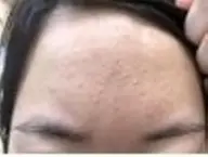 【ニキビケア/肌荒れ】生コラ導入+肌深部注入マシン(7STEP)90分¥25000→4400