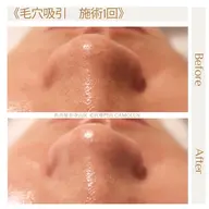 毛穴吸引コース