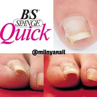 BSブレイズ巻爪ケア