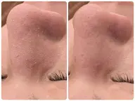 【ごっそり毛穴ケア】周南市初上陸！韓国式3D毛穴洗浄