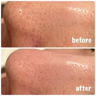 【口コミ価格】肌質改善🫧韓国肌管理💎お肌が潤う毛穴洗浄×管理栄養士による食事カウンセリング付