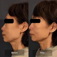 【40代以上限定】ほうれい線、たるみ、シワ、ハリ！✨田中みな実絶賛✨の炭酸ガスパック付フェイシャルメニュー✨