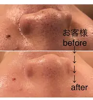 衝撃！毛穴ケアコース！何をしてもダメで鼻の毛穴ザラザラで黒いんですって方はこちら一択！1番違いがわかる！感動の体験！