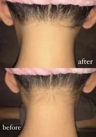 【お試し価格】えりあし・うなじ脱毛通常¥4,950→¥1,650